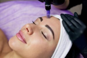 Close up a woman's face as she undergoes microneedling